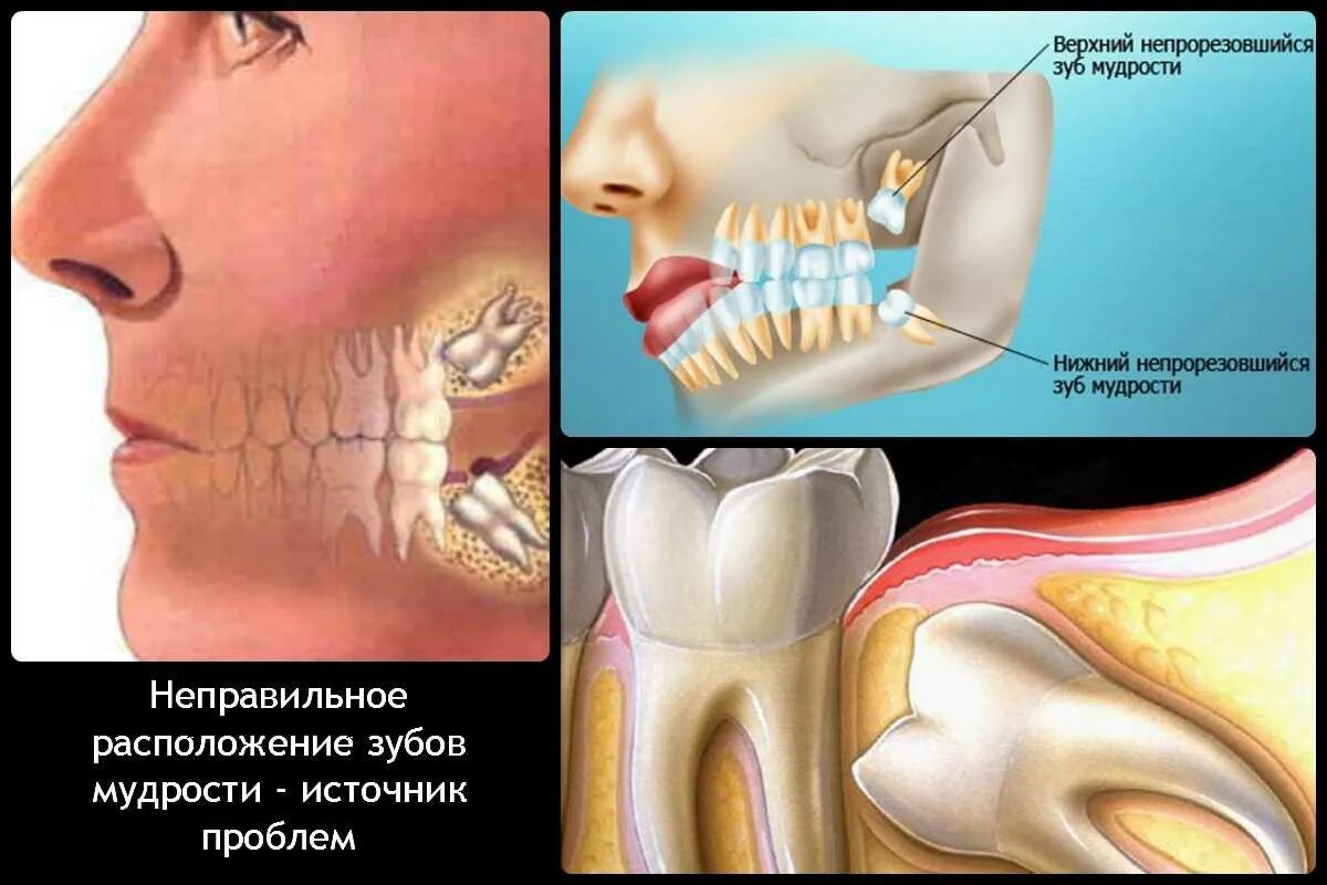 Можно ли есть зубы. Выдергивание зуба мудрости. Неправильное расположение зубов мудрости. Неправильное расположение зуба мудрости. Неправильное положение зуба мудрости.