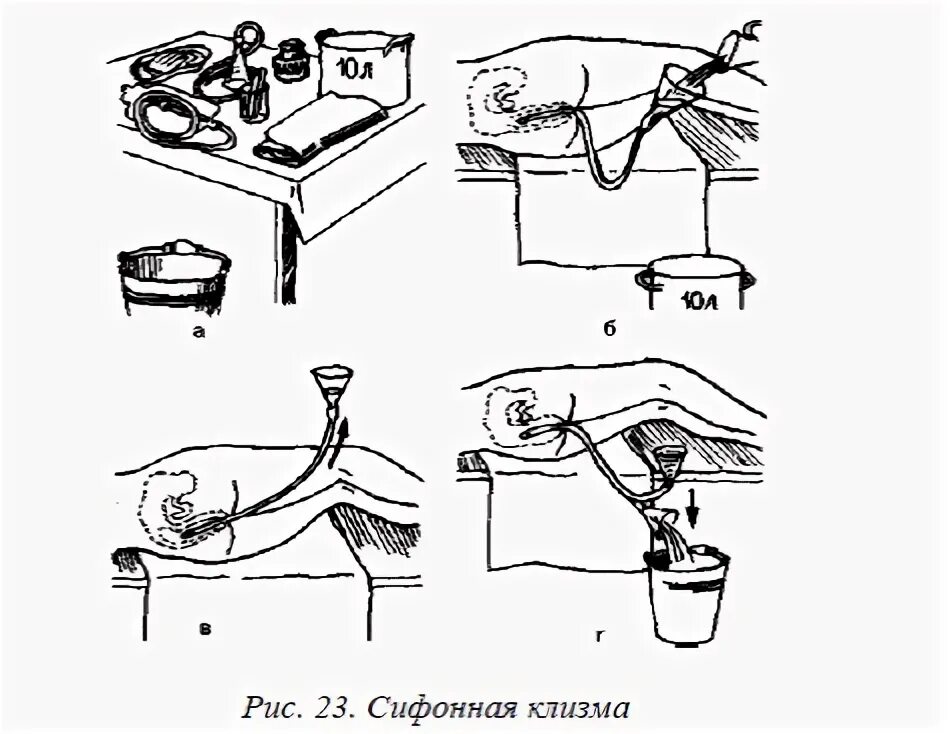 Сифонная клизма алгоритм. Техника постановки сифонной клизмы. Сифонная клизма таблица. Постановка сифонной клизмы алгоритм. После очистительной клизмы