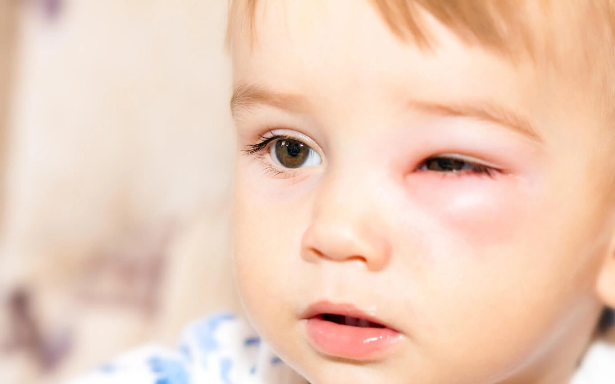 Реакция ребенка на другого ребенка. Аллергический отек глаз у ребенка. Отёк Квинке на глазах у детей.
