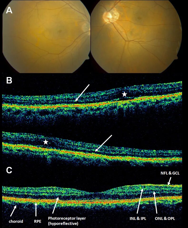 Эпиретинальный фиброз глаза. Пигментный ретинит сетчатки. Эпиретинальный фиброз сетчатки. Макулярный фиброз сетчатки. Пигментный ретинит окт.