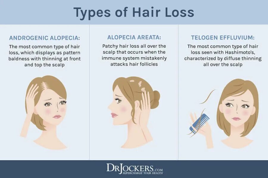 The most common type. Types of hairstyles. androgenic hair map.