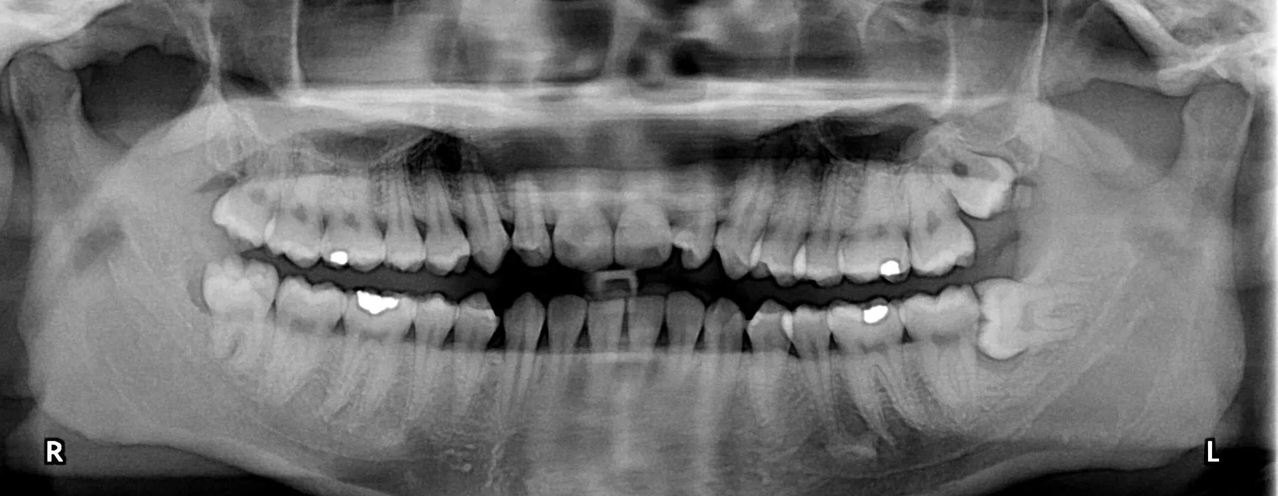Зуб 8 нижний