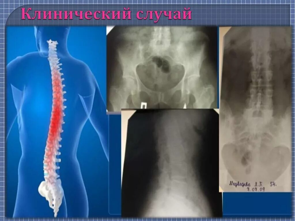 Бехтерева анкилозирующий спондилоартрит. Анкилозирующий спондилоартрит болезнь бехтерева. анкилозирующий спондилит идиопатический. анкилозирующий артрит. анкилозирующий спондилез.