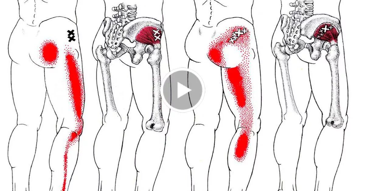 триггерные точки голени. воспаление тройничного нерва. рефлексотерапия при парезе лицевого нерва точки воздействия. фурункул волосяного фолликула. точка воспаления.