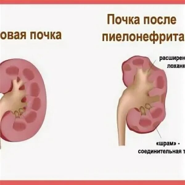 Отеки при пиелонефрите