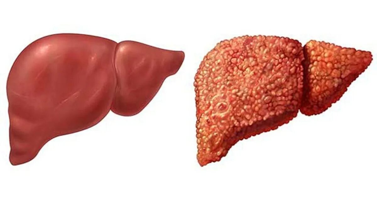 Печень здоровая и больная. Здоровая печень и цирроз. Печень здорового человека и больного.