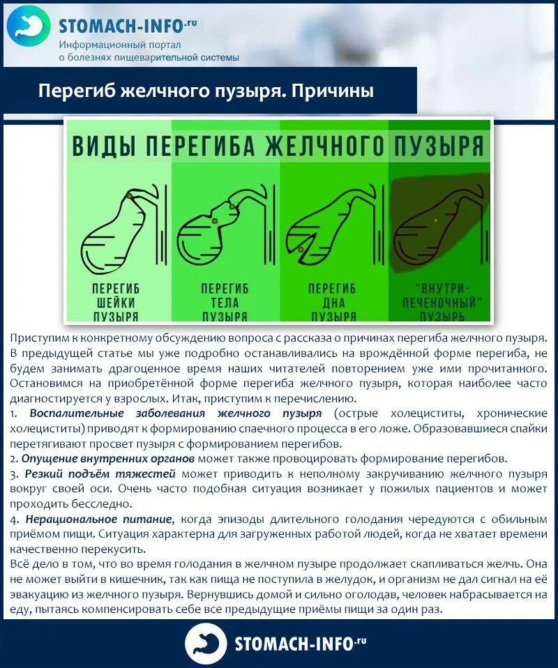 Изгиб шейки желчного. Изгиб желчного пузыря симптомы. Загиб Перегиб желчного пузыря. Перегиб желчного пузыря в средней трети. Анатомический Перегиб желчного пузыря.