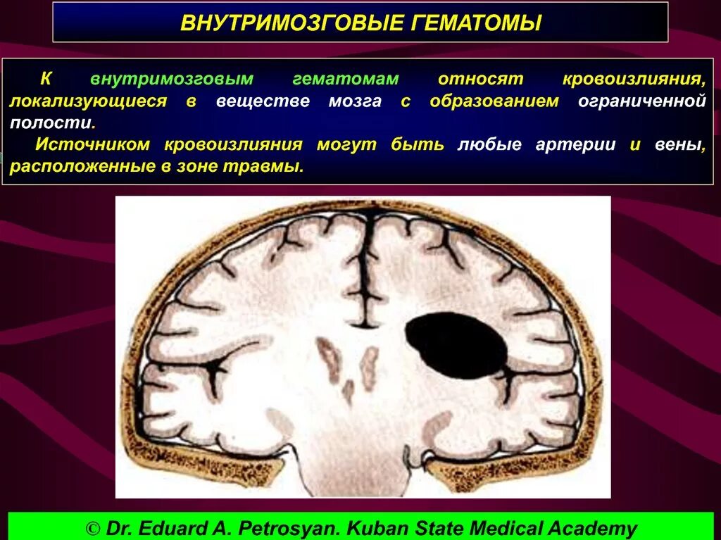 Внутримозговая гематома. Внутримозговые тератомы. Внутримозговое кровоизлияние. Внутримозговая гематома головного мозга. Проведенные на головном мозге