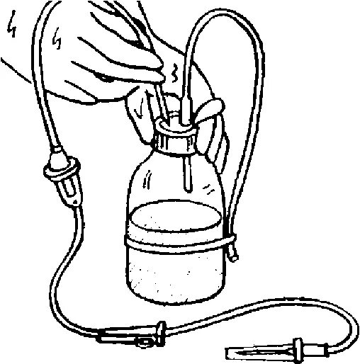 Заполнение системы для капельного вливания алгоритм. Заполнение системы для капельного вливания. Система для внутривенного капельного вливания. Техника внутривенного капельного вливания раствора. Устройство системы для внутривенного капельного вливания.