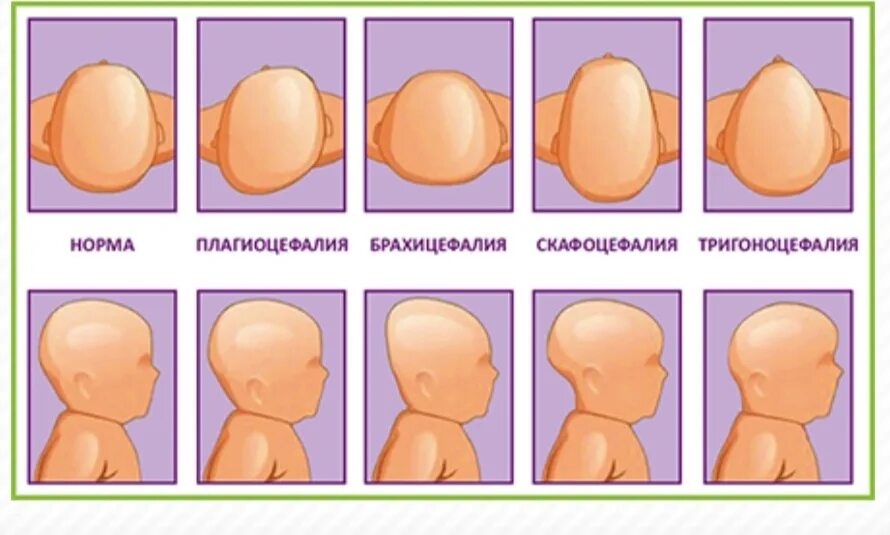 Мозг новорожденного норма. Форма черепа у грудничка норма. Форма головы у грудничка норма. Форма головы у 2 месячного ребенка норма. Форма черепа у грудничка 4 месяца.