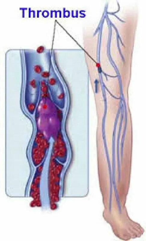 Флеботромбоз глубоких вен нижних конечностей. Тромбофлебит и флеботромбоз симптомы. Флебит поверхностных вен. Поверхностный флебит, тромбофлебит. Как снизить тромбоз