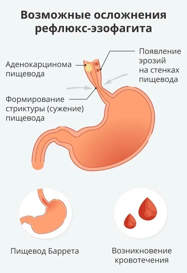 Лекарство от рефлюкса желудка