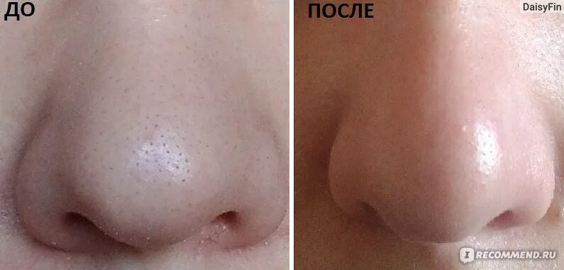 Маска-плёнка для очищения пор. Пенка для умывания 200 мл. Очищение пор содой. Очищение пор содой. Чистка лица.