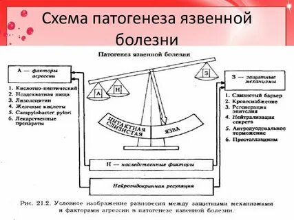 Патогенез язвенной болезни желудка и двенадцатиперстной кишки