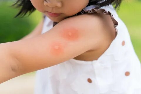 mosquito-bites 