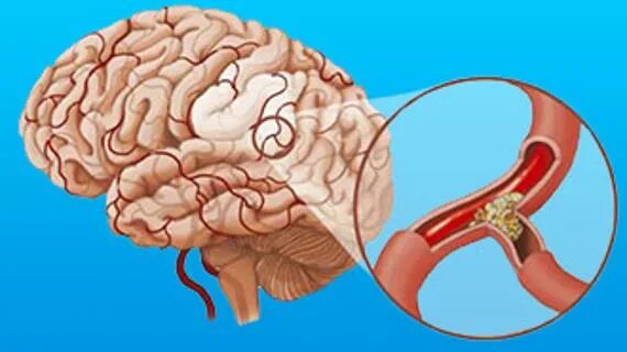 Всд голова. Ангиодистония сосудов головного мозга что это такое. Ангиодистония церебральных сосудов. Церебральная дистония. Сосудистая дистония головного мозга.