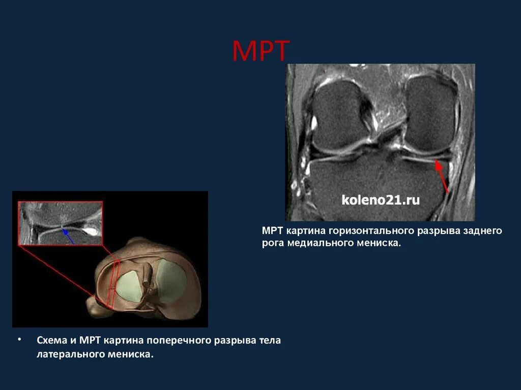 Разрыв медиальной. Разрыв мениска мрт классификация. Разрыв заднего рога медиального мениска на мрт. Горизонтальный разрыв мениска коленного сустава на мрт.