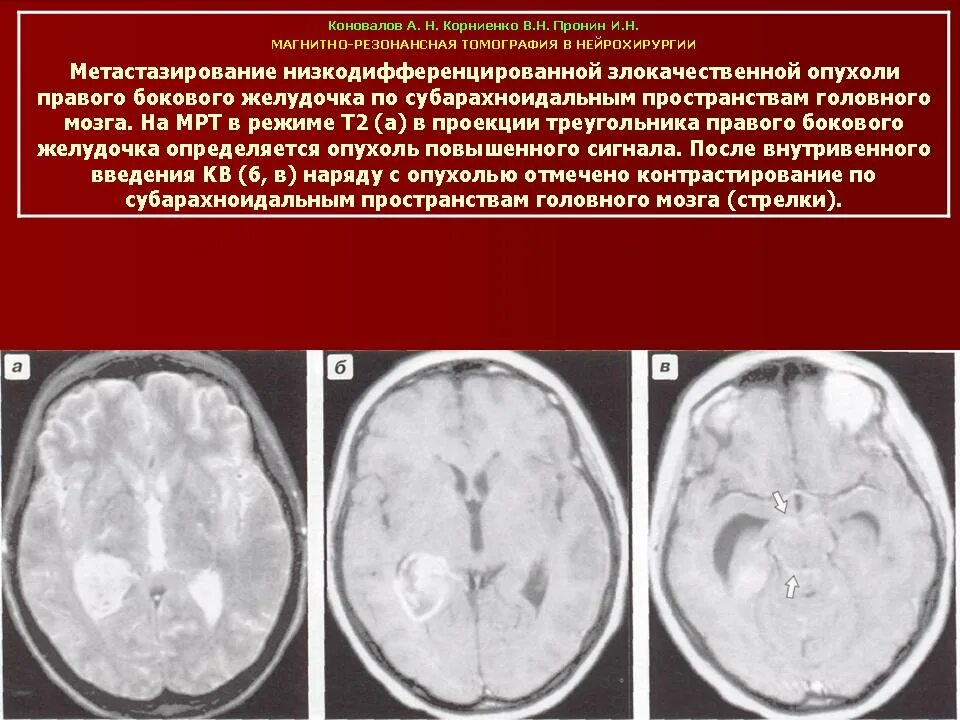 Опухоли желудочков. Метастазы головного мозга кт. Опухоль желудочка головного мозга. Опухоль четвертого желудочка головного мозга. Опухоли третьего желудочка.