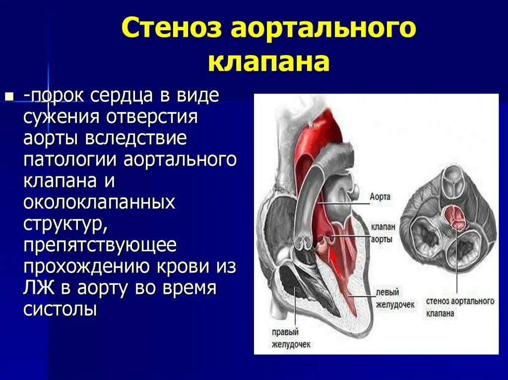 Сердечный стеноз. Порок аортального клапана сердца. Стеноз двустворчатого аортального клапана. Стеноз и недостаточность аортального клапана. Порок сердца двустворчатый аортальный клапан.