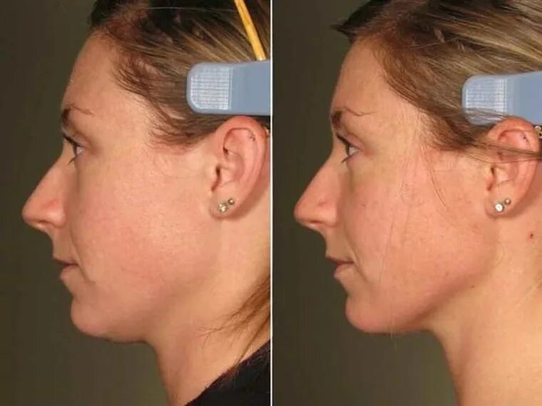 Ultherapy before and after at Laser Clinique San Diego Skin care routine steps, 