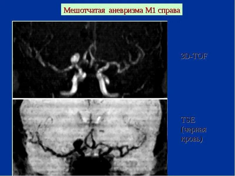 Мешотчатая аневризма внутренней. Мешотчатая аневризма вса. аневризма передней мозговой/передней соединительной артерии.. мешотчатая аневризма средней мозговой артерии головного мозга.
