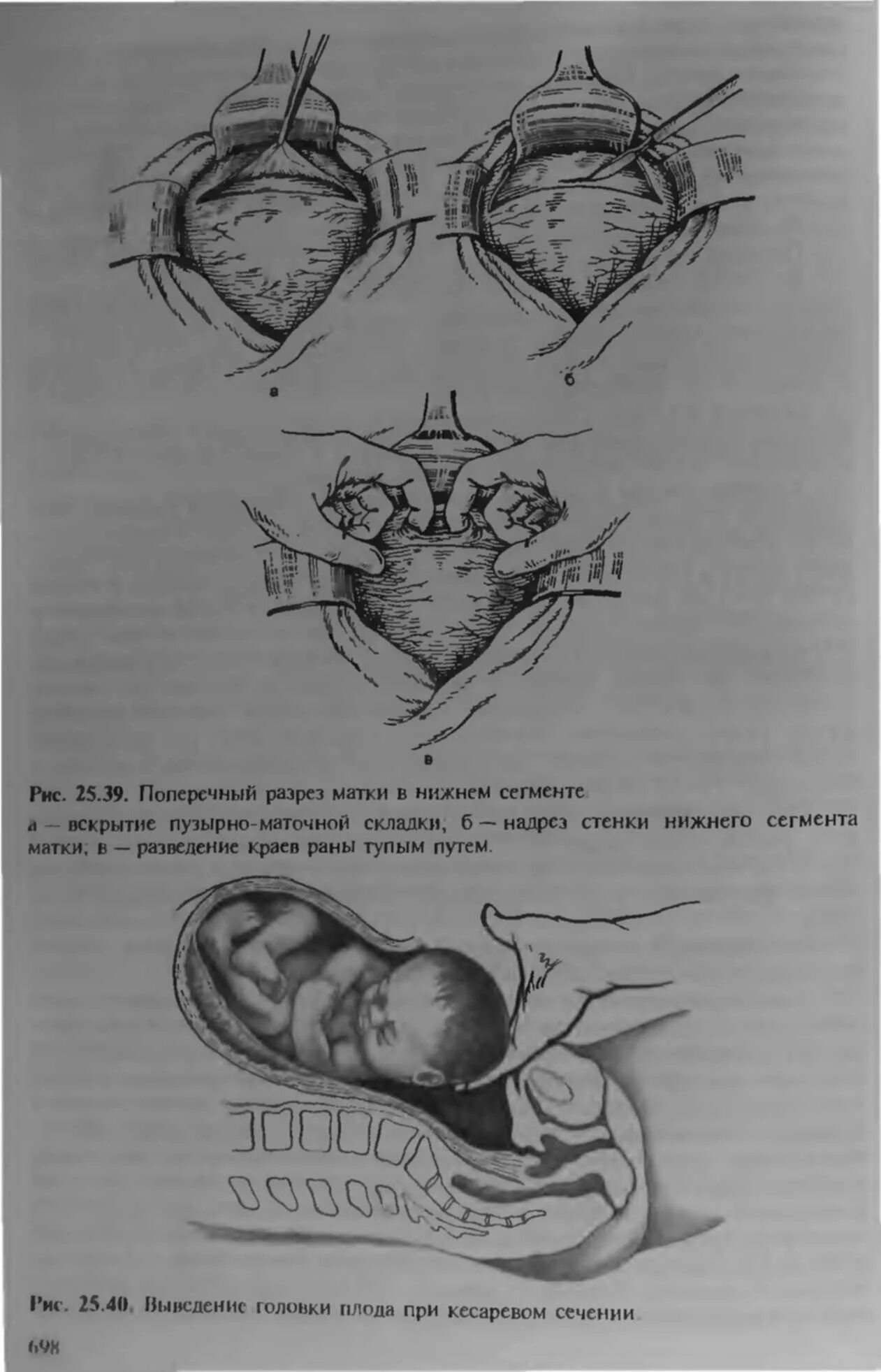 Кесарево сечение при поперечном предлежании. Ретровезикальное кесарево сечение. Кесарево сечение тазовое предлежание. Кесарево сечение ушивание матки. После кесарева сечения через сколько можно беременеть