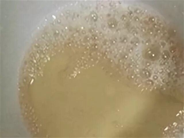 Мед с пузырьками. Моча пенится у женщин. Пузырьки на поверхности мочи. Непрозрачная моча. Моча в стакане.