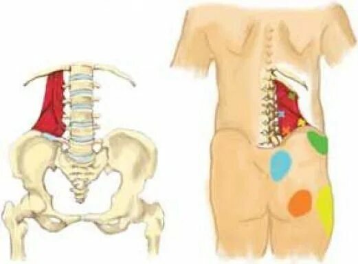 Сильно болит крестец. Миофасциальный синдром квадратной мышцы поясницы. Миофасциальный болевой синдром квадратной мышцы поясницы. Квадратная мышца поясницы сколиоз. Миофасциальный синдром квадратной мышцы.