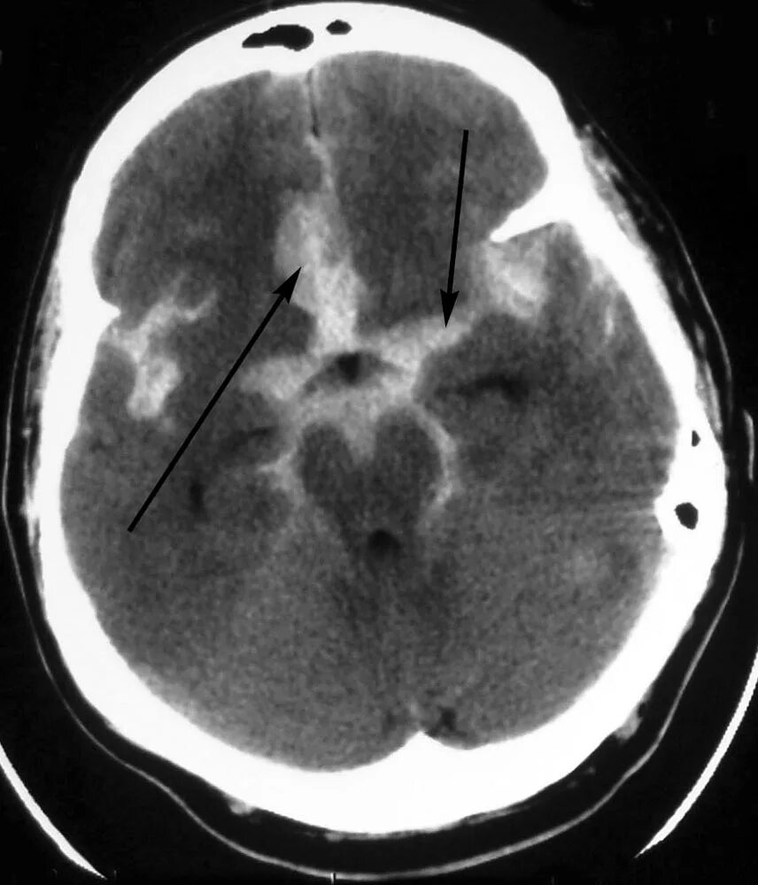 Субарахноидальное кровоизлияние кт. Суарахноидальное кровизлияниект. Субарахноидальное кровоизлияние головного кт. Субарахнодиальное кровоизляиние СКТ. Травматическое кровоизлияние