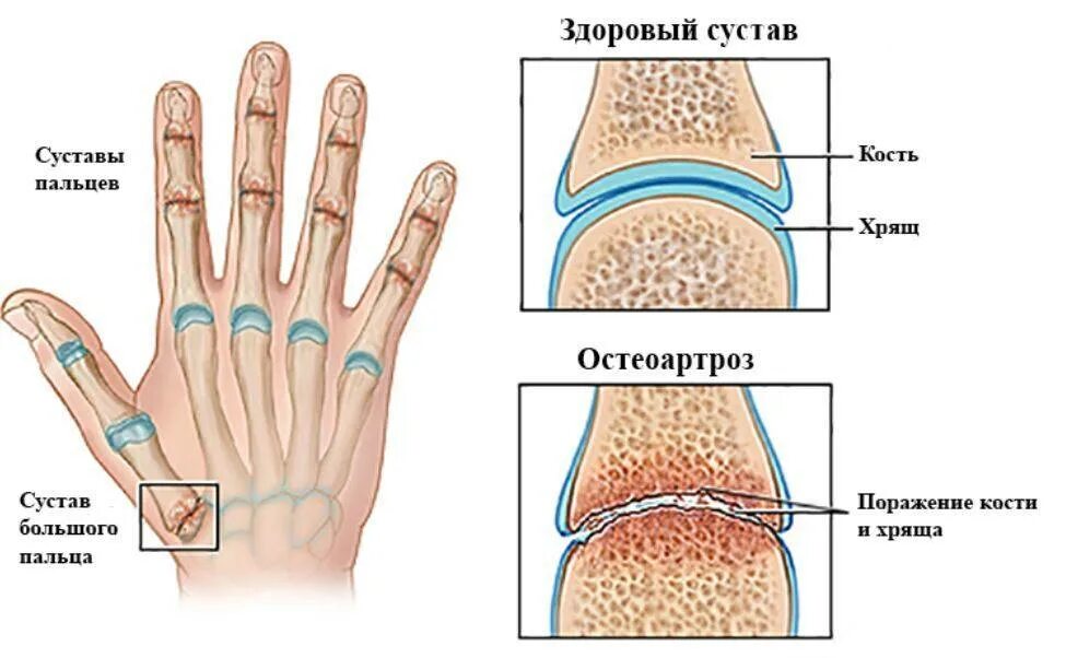 Хрустит запястье