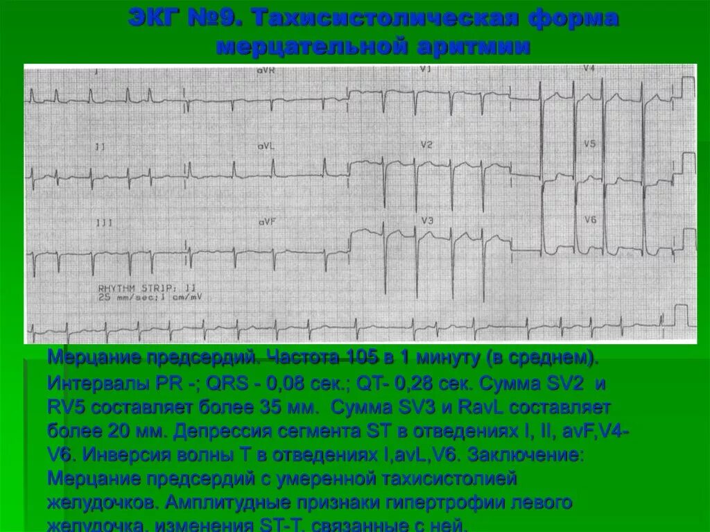 Постоянная фибрилляция предсердий тахисистолическая форма. Тахисистолический вариант фибрилляции. Тахиформа фибрилляции предсердий на экг. Тахисистолический вариант фибрилляции. Тахисистолический вариант фибрилляции.