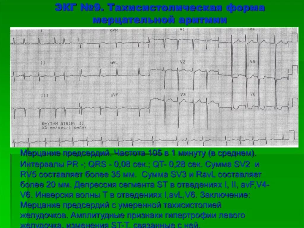 Тахисистолия это. Фибрилляция предсердий тахисистолическая форма ЭКГ. Фибрилляция предсердий тахисистолическая на ЭКГ. ЭКГ фибрилляция предсердий заключение. Пароксизмальная форма фибрилляции предсердий ЭКГ.