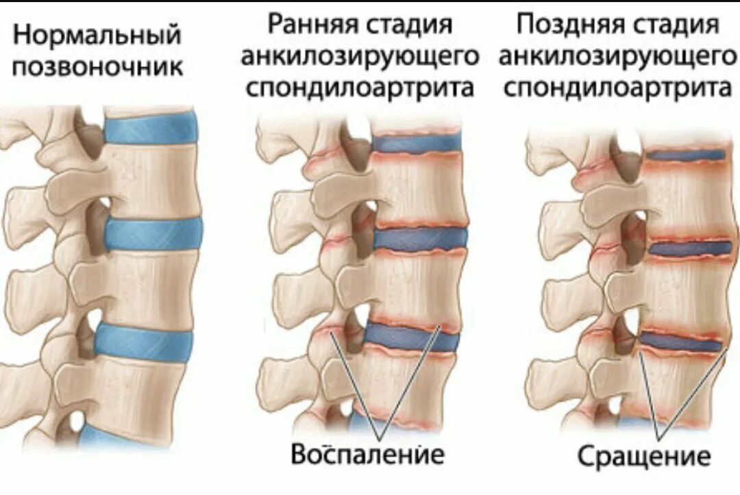Анкилозирующий спондилит инвалидность. Анкилозирующий спондилит синдесмофиты. спондилит анкилозирующий поясничного отдела. болезни бехтерева (анкилозирующего спондилита) рентген. анкилозирующий спондилит болезнь бехтерева.