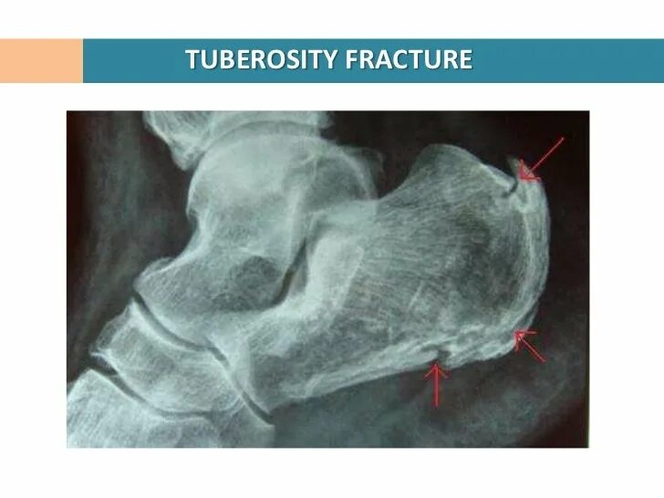 Пяточная кость рентген перелом. Перелом пяточной кости рентген. Языкообразный перелом пяточной кости. Костная мозоль после перелома пяточной кости.