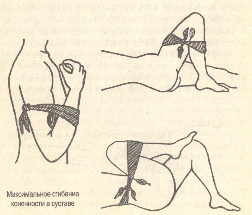 Остановка кровотечения путем сгибания конечности. Остановка кровотечения методом максимального сгибания конечности. Остановка кровотечения максимальным сгибанием конечности в суставе.. Максимальное сгибание конечности в суставе. Остановка наружного кровотечения способом сгибания конечности.