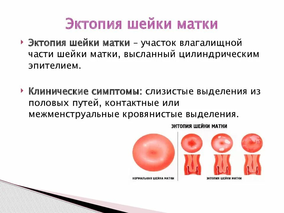 Доброкачественные заболевания шейки. Эктропион цилиндрического эпителия это. Эктопия цилиндрического эпителия 1 Тип. Воспалительные заболевания шейки матки клинические рекомендации.