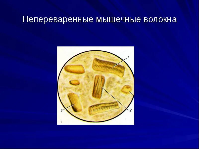 Растительная клетчатка в копрограмме. Микроскопия кала растительная клетчатка непереваримая. Микроскопия кала мышечные волокна. Мышечные волокна в Кале микроскопия. Непереваримая клетчатка в Кале микроскопия.