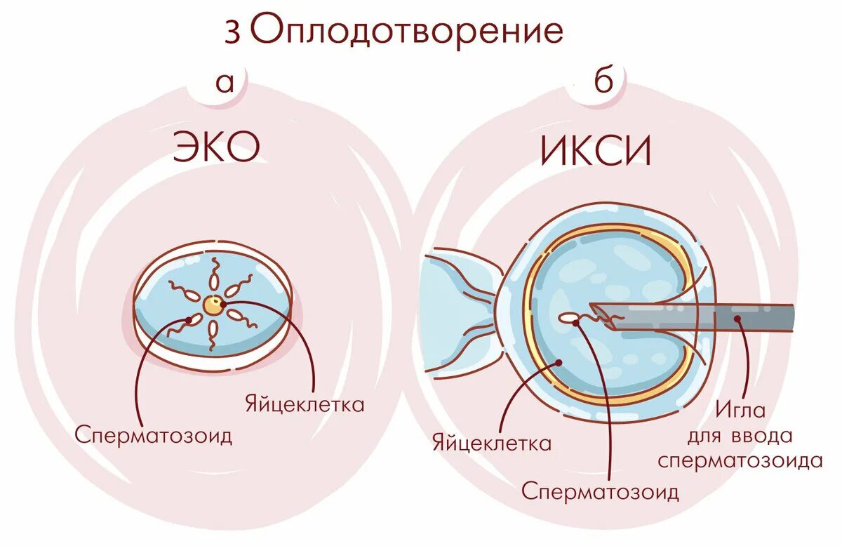 Оплодотворение яйцеклетки ИКСИ. Инъекция сперматозоида в цитоплазму клетки (ИКСИ).. Эко ИКСИ. ИКСИ оплодотворение что это. Этапы эко по дням