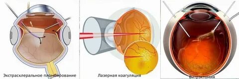 Операция на сетчатку