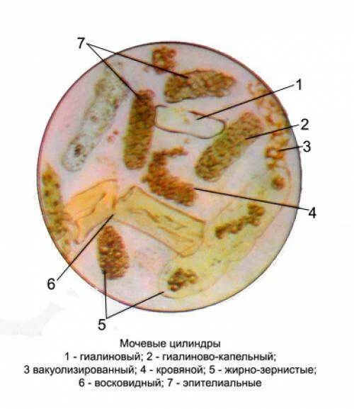 Повышены цилиндры в моче. Гиалиновый цилиндр в моче микроскопия. Гиалиновые и зернистые цилиндры. Гиалиновый цилиндр в осадке мочи. Гиалиновые цилиндры микроскопия.