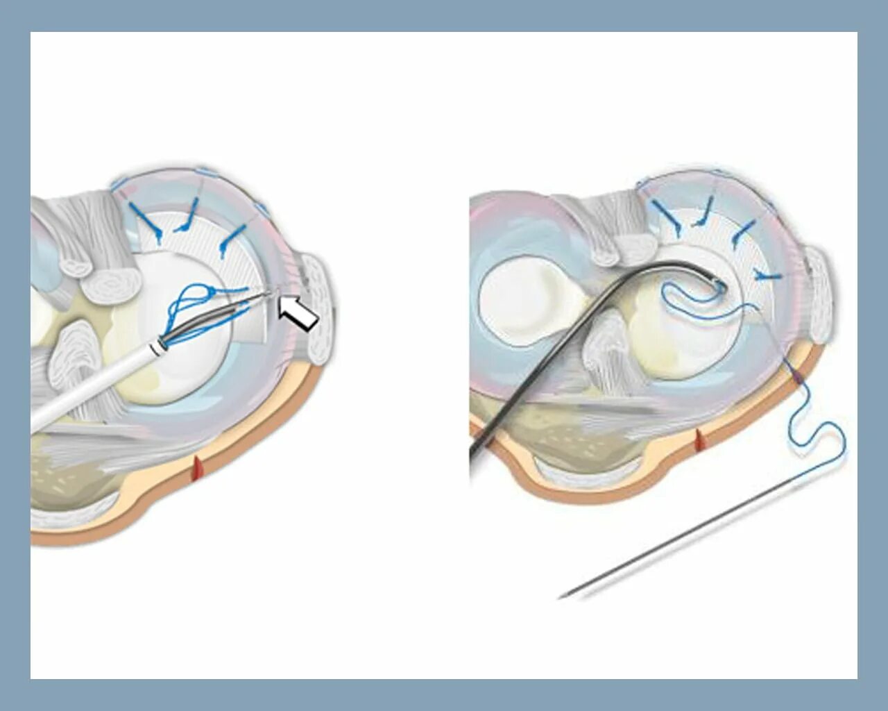 Артроскопическая резекция медиального мениска. Разрыв мениска коленного сустава ручка лейки. Повреждение мениска ручка лейки. Артроскопическое сшивание мениска.
