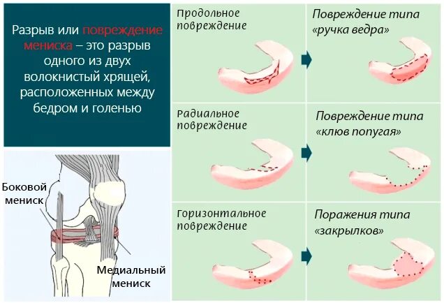 Повреждение мениска коленного сустава по stoller. Классификация по Stoller повреждение мениска. Разрыв внутреннего мениска 3 степени по Stoller. Горизонтальный разрыв заднего рога мениска 3 степени. Внутренний мениск горизонтальный продольный разрыв.