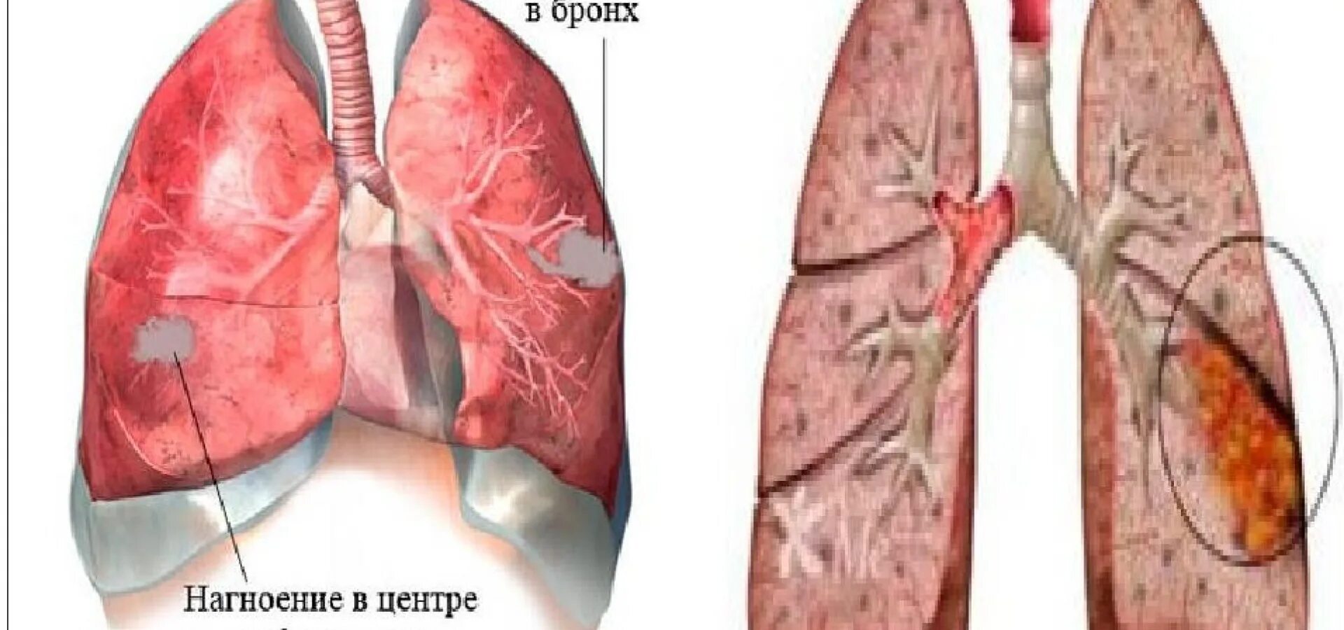 Гнойные абсцессы легких. Бронхогенный абсцесс легкого. Плеврит абсцесса легких. Плеврит и бронхоэктазы. Хронический абсцесс легкого.