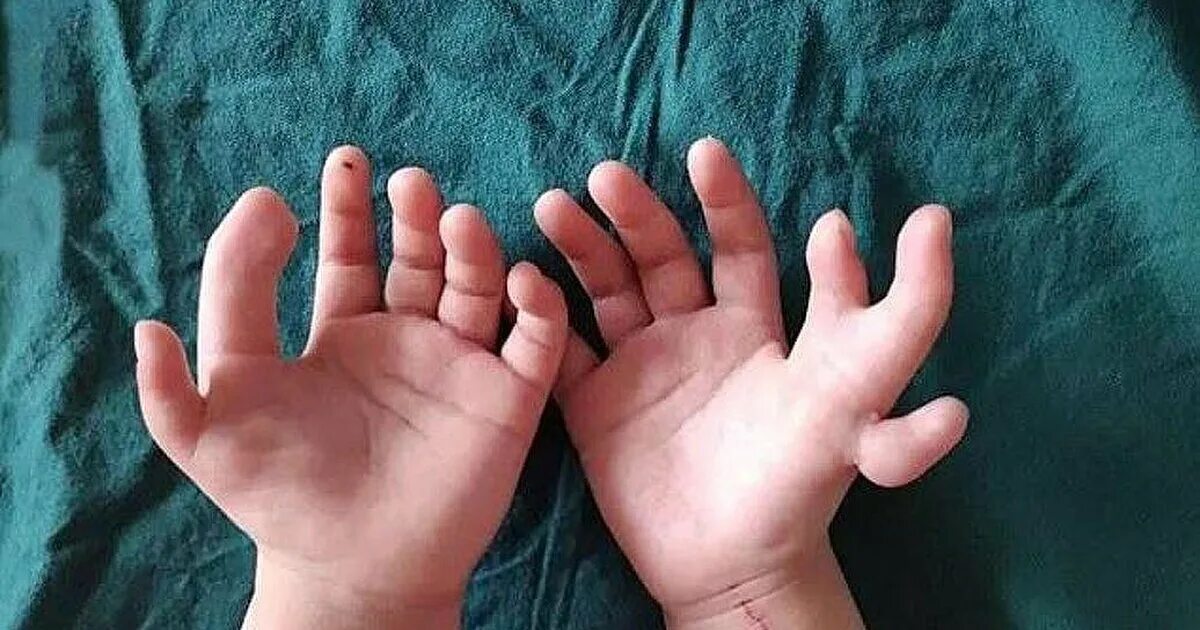 6 пальцев на руках у детей