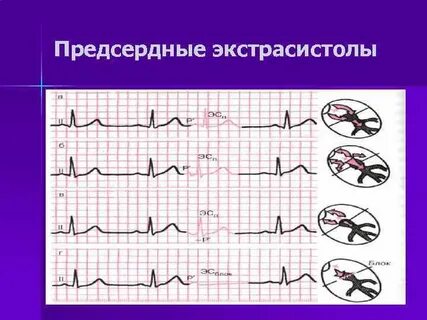 Предсердные экстрасистолы
