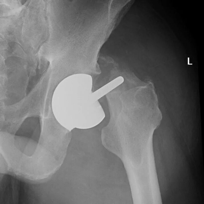 Осложнения после эндопротезирования тазобедренного