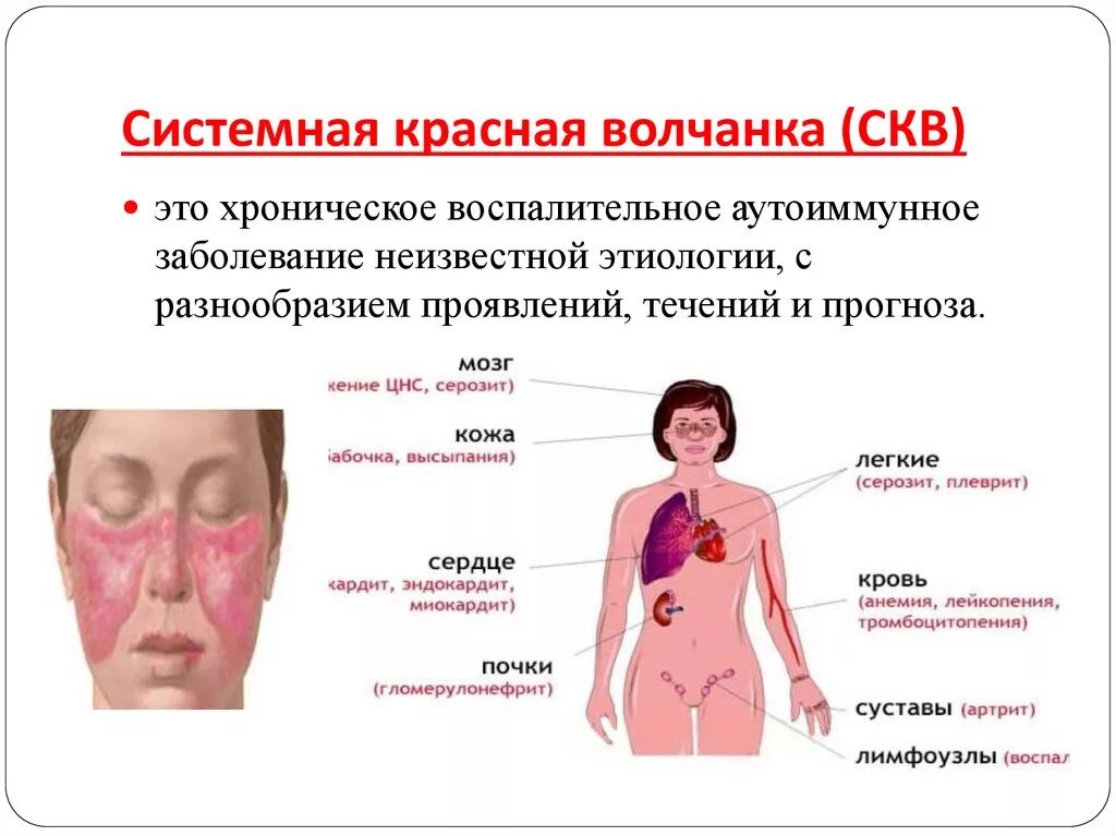 Чем грозит воспаление. Системная красная волчанка кожные симптомы. Системная красная волчанка клинические рекомендации 2020. Системная красная волчанка это аутоиммунное заболевание. Сыпь при системной красной волчанке.