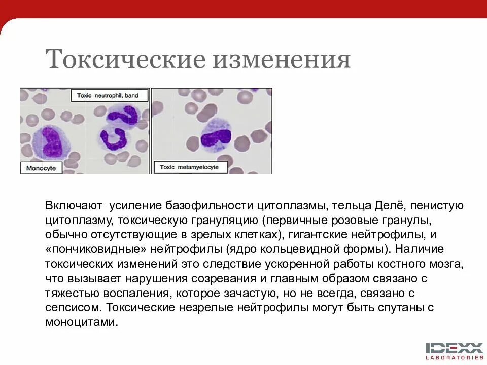 Морфология: токсигенная зернистость нейтрофилов. Токсогенная зернистость нейтрофилов. Токсич зернистость нейтрофилов. Токсикогенная зернистость нейтрофилов. Изменения лейкоцитов в крови