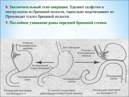 Операция при 1 стадии
