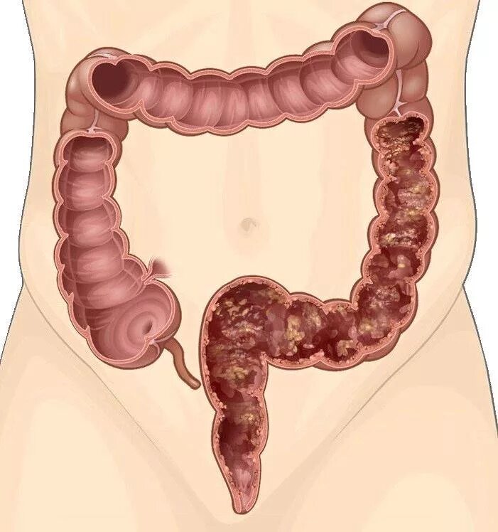 Язвенный колит толстой кишки. Язвини колить толскишка. Толстый кишечник долихосигма. Что такое язвенный колит Толстого кишечника.